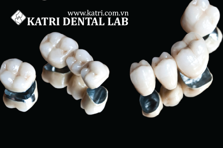 Thời gian bảo hành răng sứ là bao lâu?